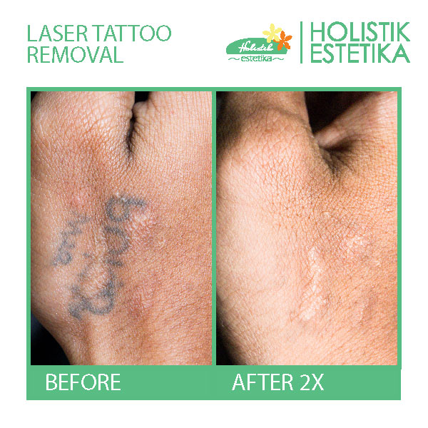 Before After tattoo1