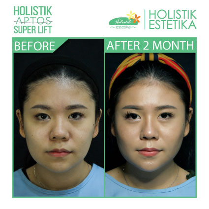 Hasil 2 Bulan Setelah Treatment
