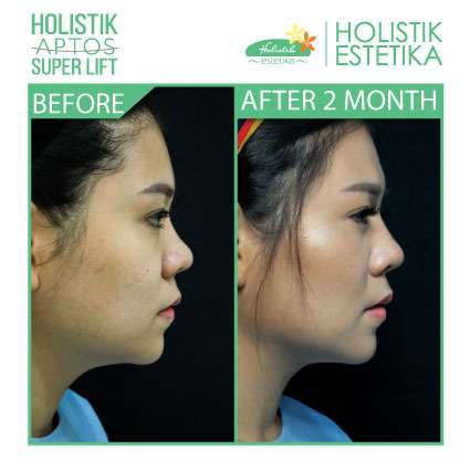 Hasil 2 Bulan Setelah Treatment