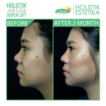 Hasil 2 Bulan Setelah Treatment