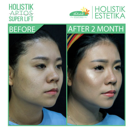 Hasil 2 Bulan Setelah Treatment