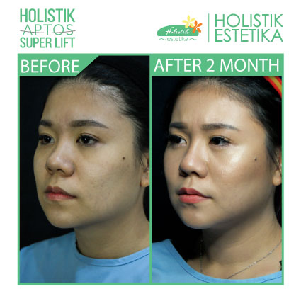 Hasil 2 Bulan Setelah Treatment