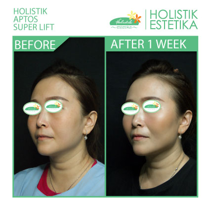 Hasil 1 Minggu Setelah Treatment