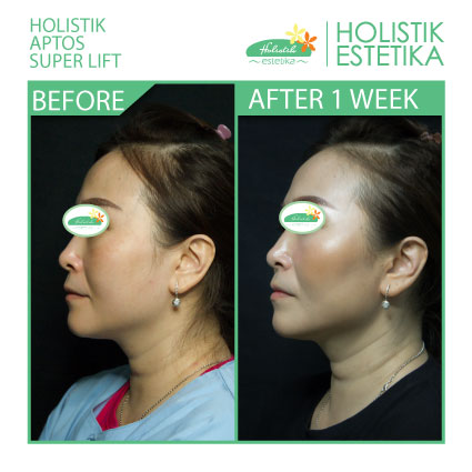 Hasil 1 Minggu Setelah Treatment