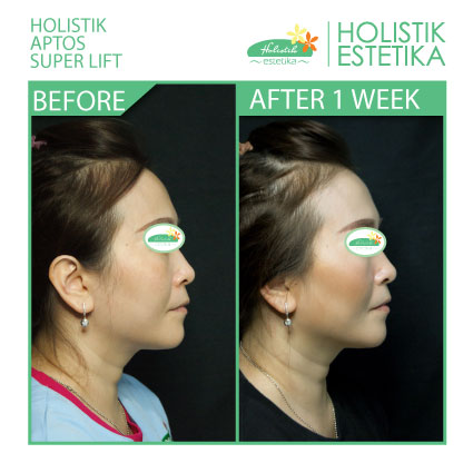 Hasil 1 Minggu Setelah Treatment