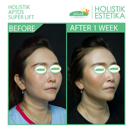 Hasil 1 Minggu Setelah Treatment