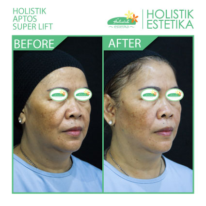 Hasil Langsung Setelah Treatment