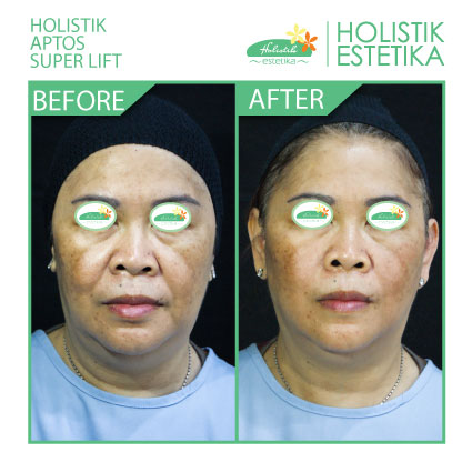 Hasil Langsung Setelah Treatment