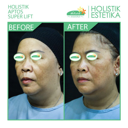 Hasil Langsung Setelah Treatment