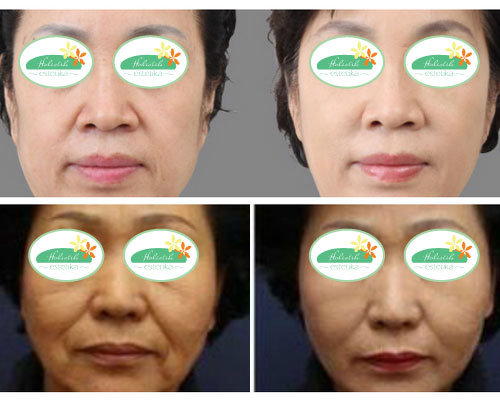 Before After HIFU 1