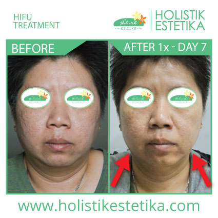 Before After HIFU 2a