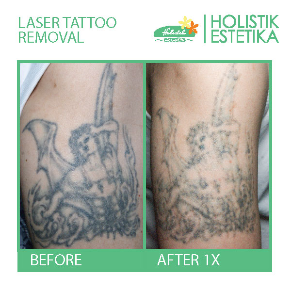 Before After tattoo