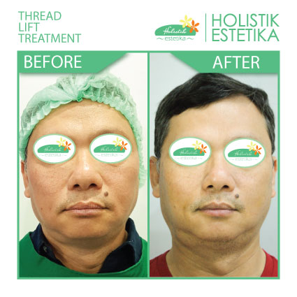 Before After thread lift