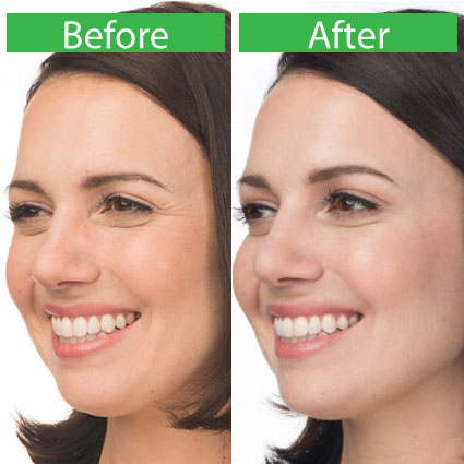 Botox Treatment