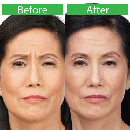 Botox Treatment