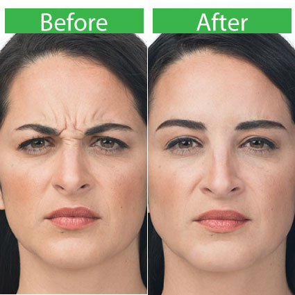 Botox Treatment