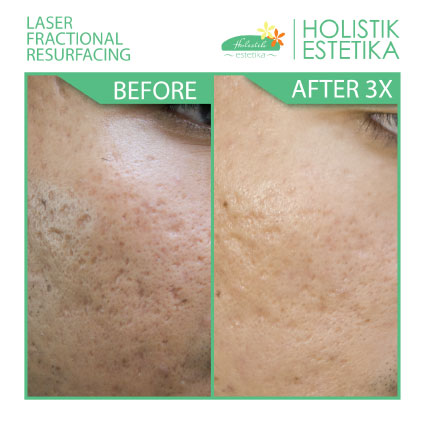 Acne Scar Laser
