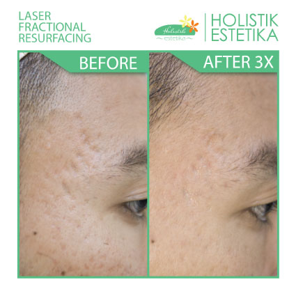 Acne Scar Laser