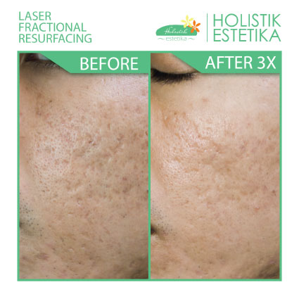 Acne Scar Laser