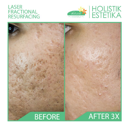 Acne Scar Laser