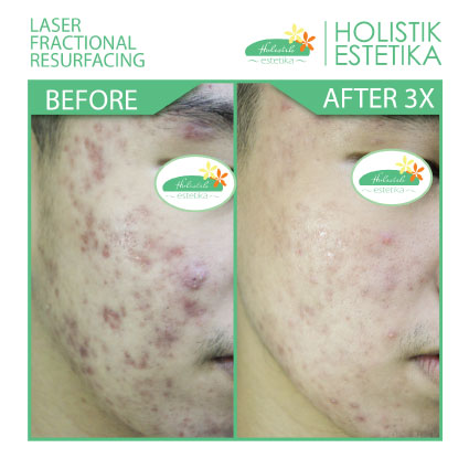Acne Scar Laser