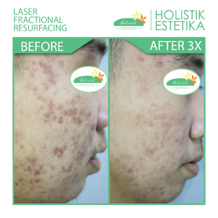 Acne Scar Laser