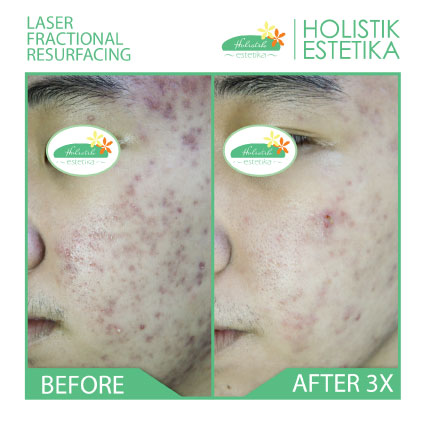 Acne Scar Laser