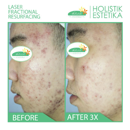 Acne Scar Laser