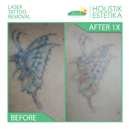 Setelah Treatment Pertama