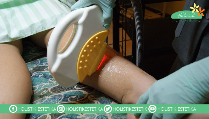 IPL hair removal 1