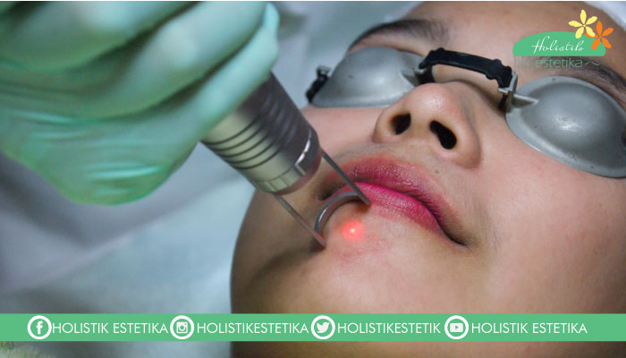 Laser Toning Melasma 1